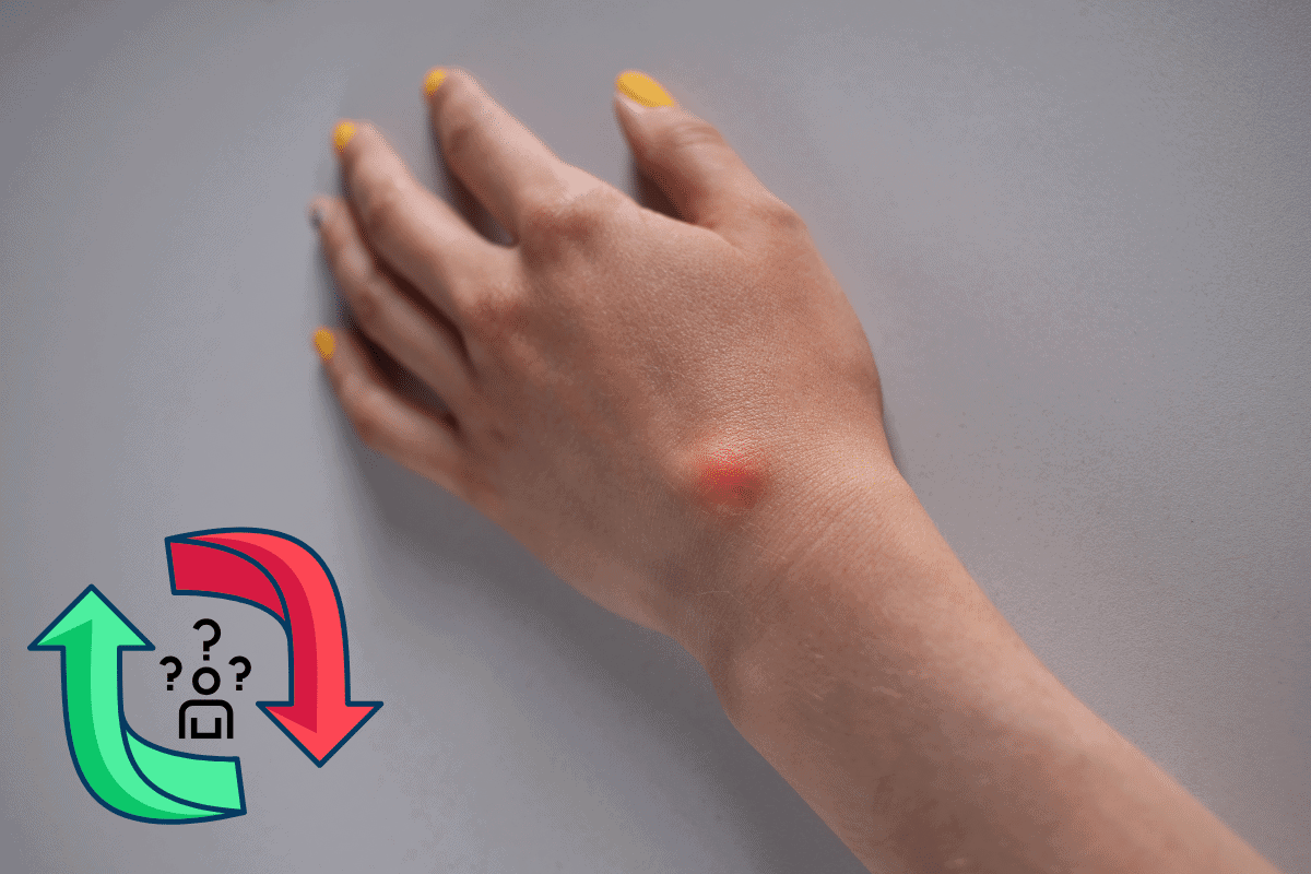 What to do if a ganglion cyst comes back after surgery