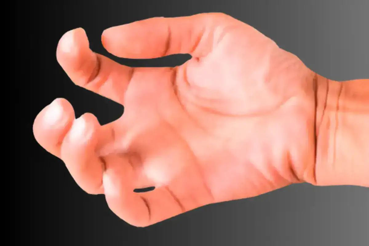 Spasticity after stroke or injury