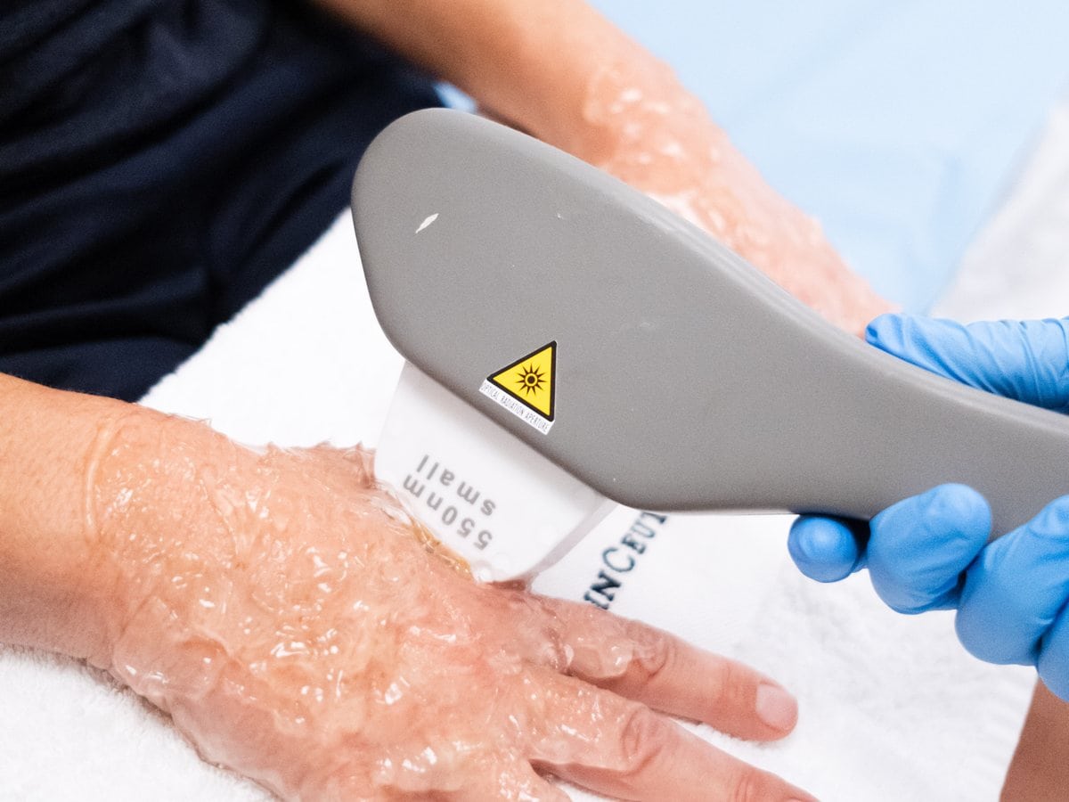 Tratamiento con láser en la mano en Clínica Fontana, Valencia