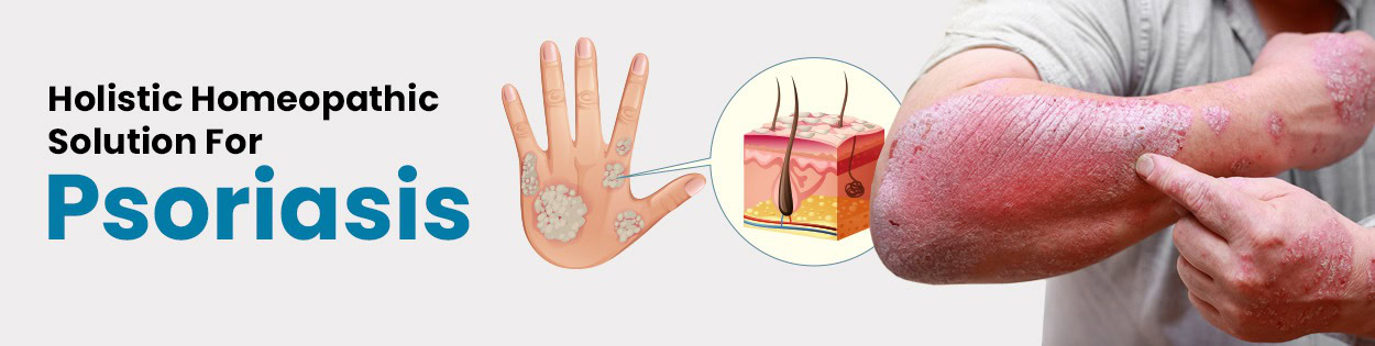 Comparison of psoriasis types including plaque, guttate, and scalp psoriasis with information on natural homeopathic treatment at Dr. Care.