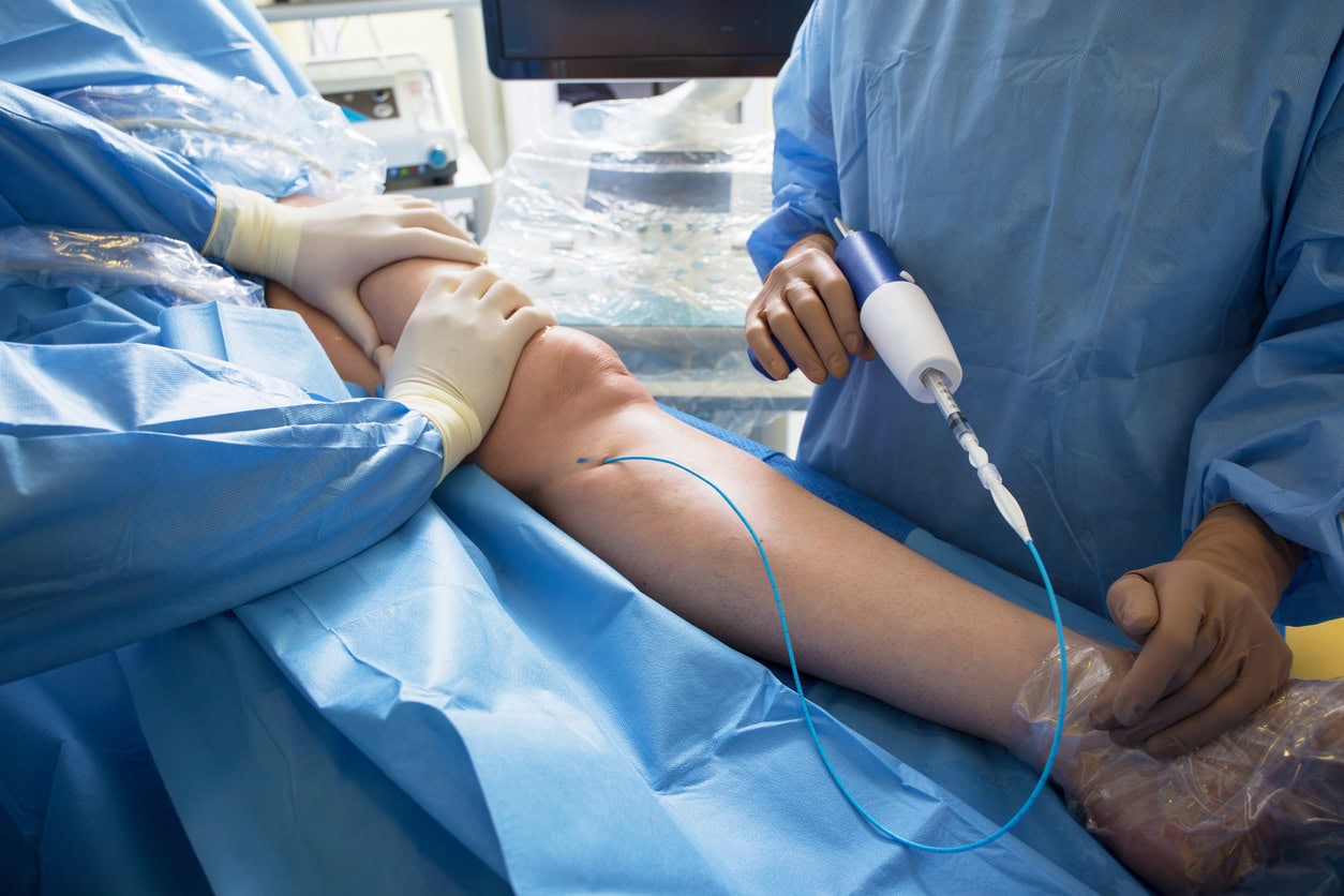 Vein care specialist performing endovenous ablation procedure on patient’s leg in sterile clinical setting | The Vein Guys