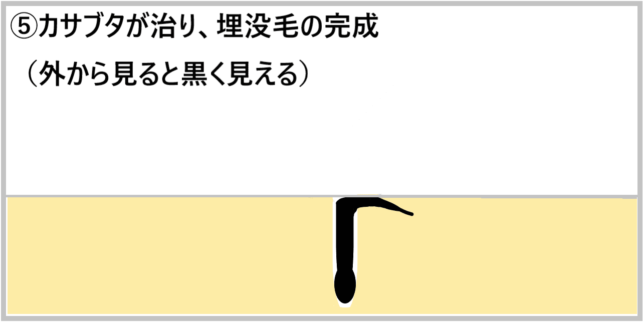 ⑤カサブタが治り、埋没毛の完成（外から見ると黒く見える）の画像