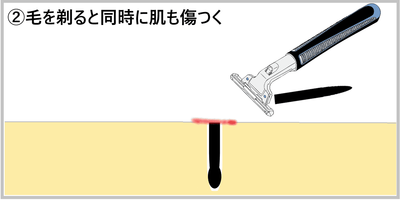 ②毛を剃ると同時に肌も傷つく画像