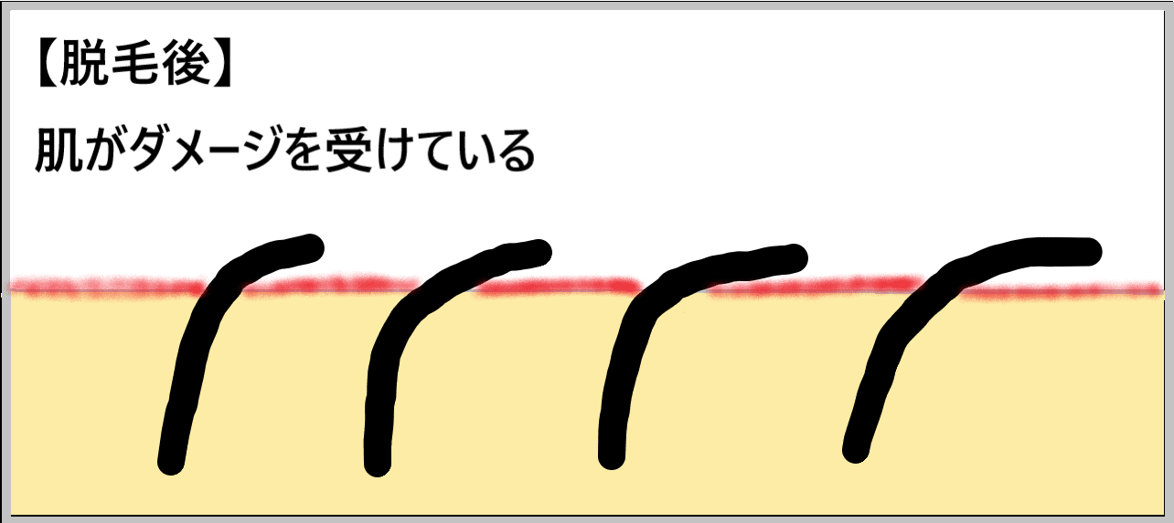 脱毛後は肌がダメージを受けていることを示した画像