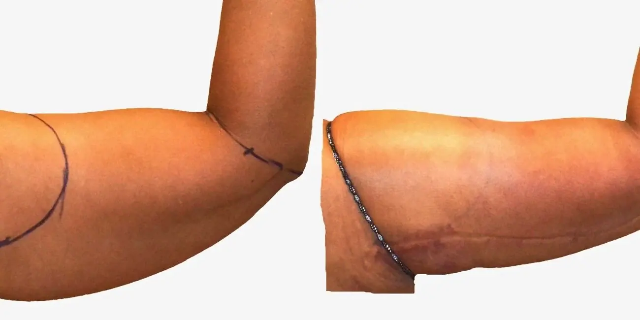 Arm liposuction before and after, actual patient of Dr. Long