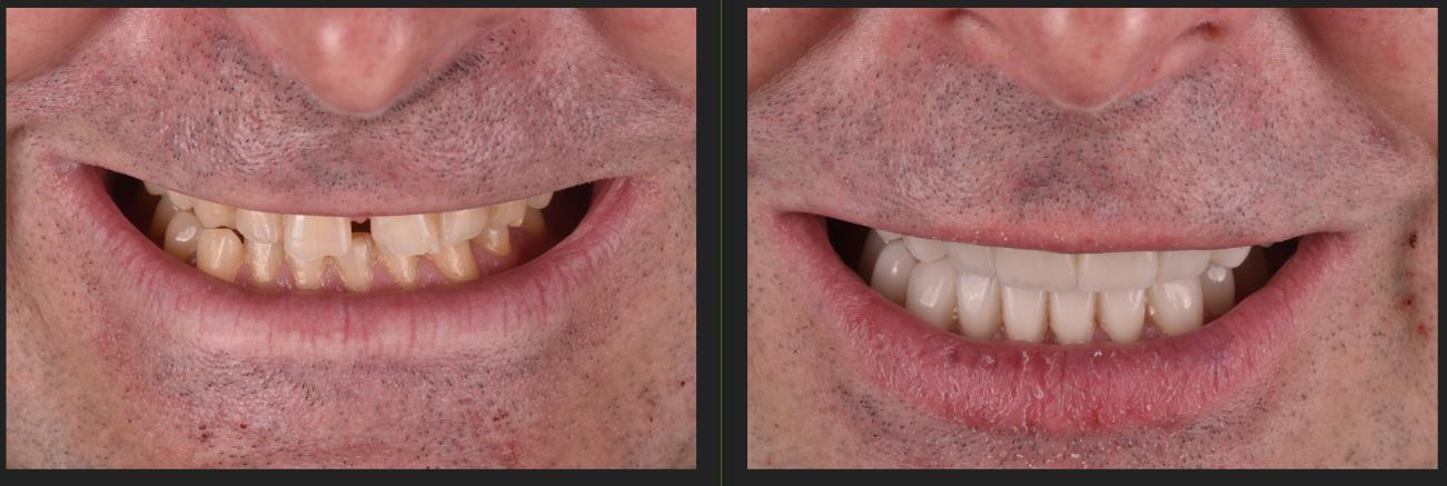 Antes y después de una sonrisa