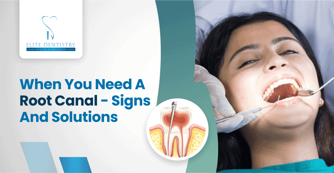 Blog Cover image: Root Canal