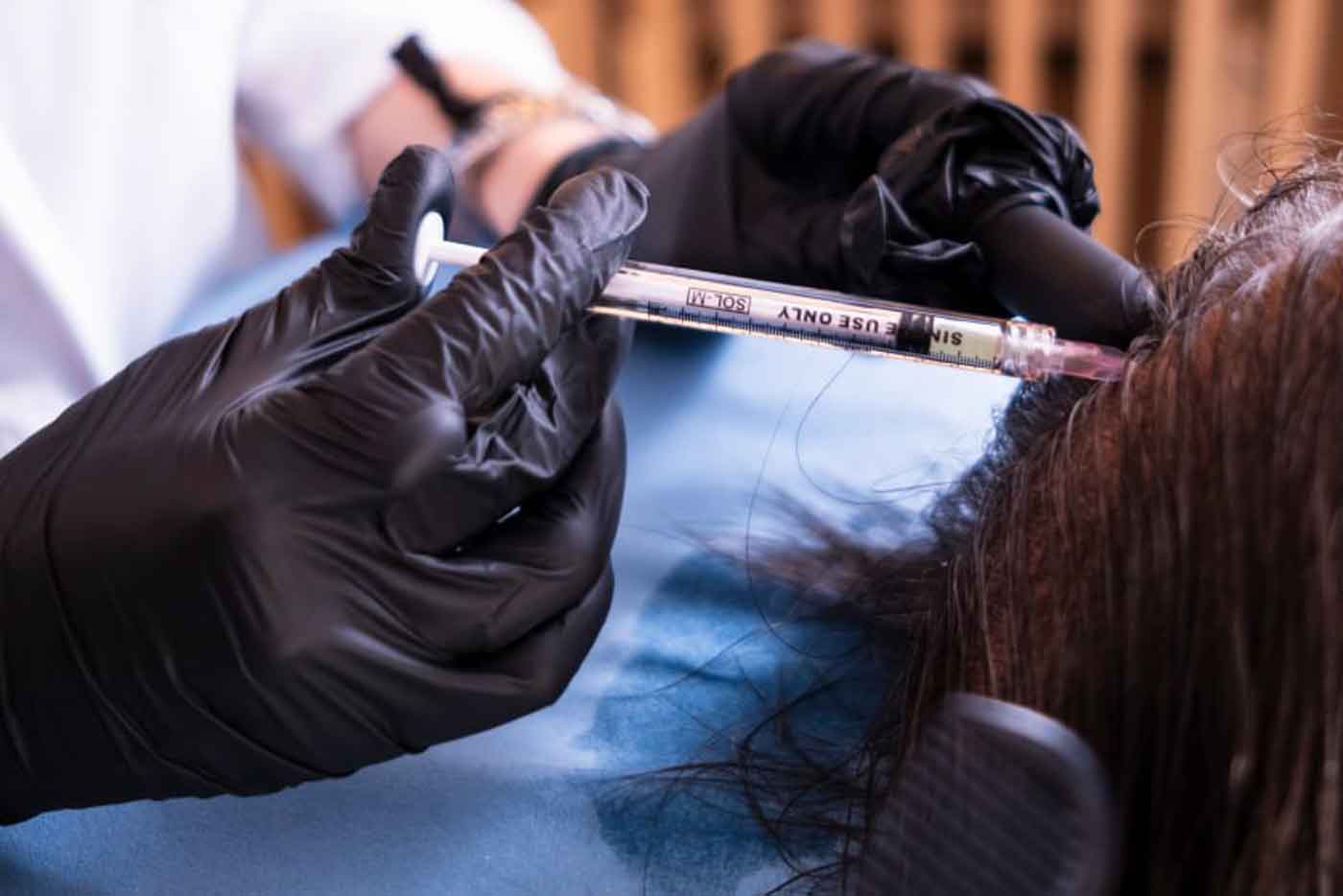 Aplicación de mesoterapia capilar en la unidad capilar de Hospital Clínica Fontana
