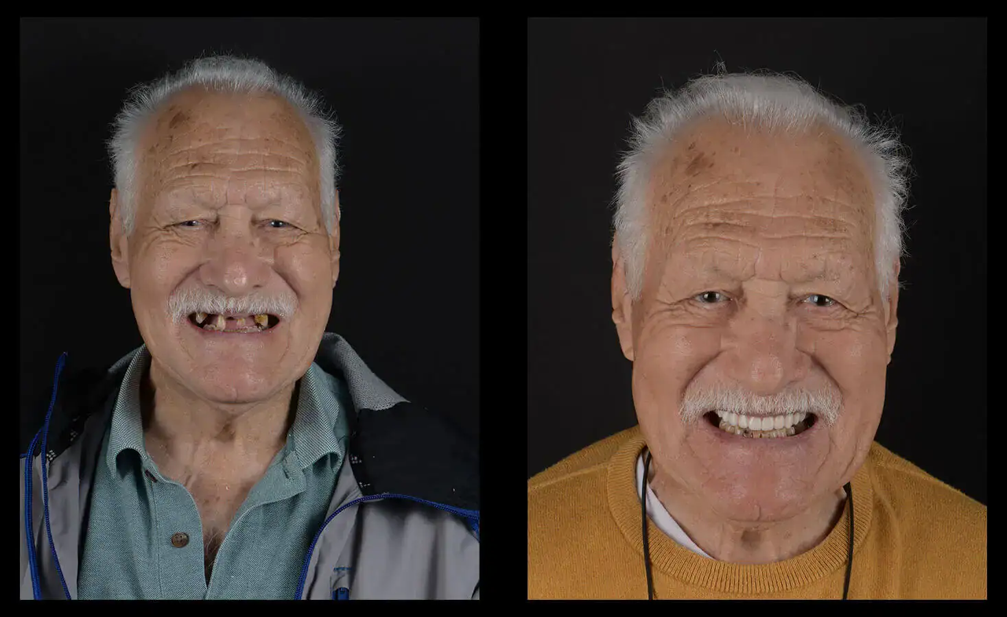 dental implants austin