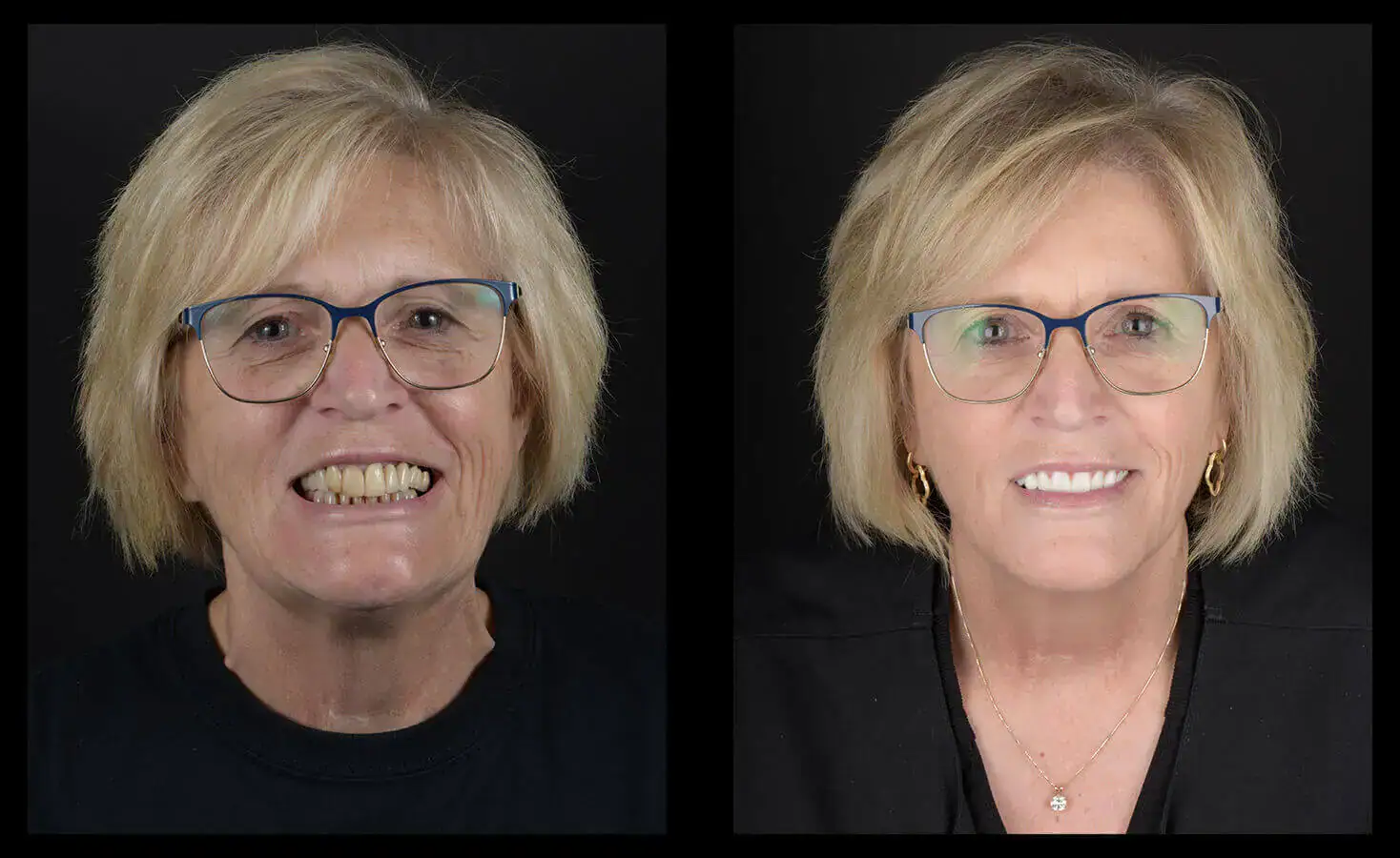 dental implants austin