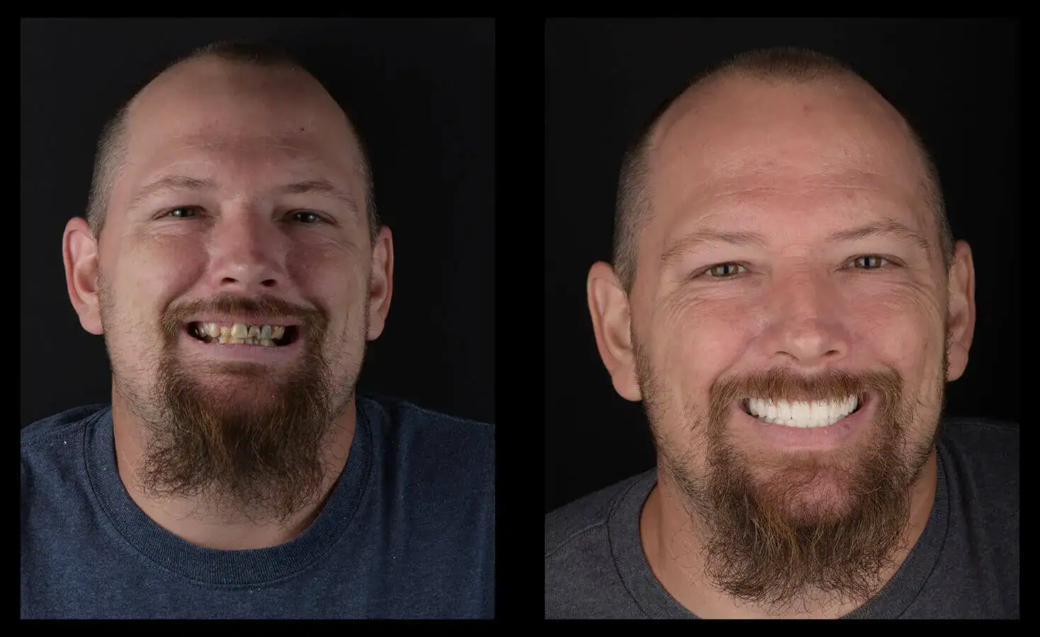 dental implants austin