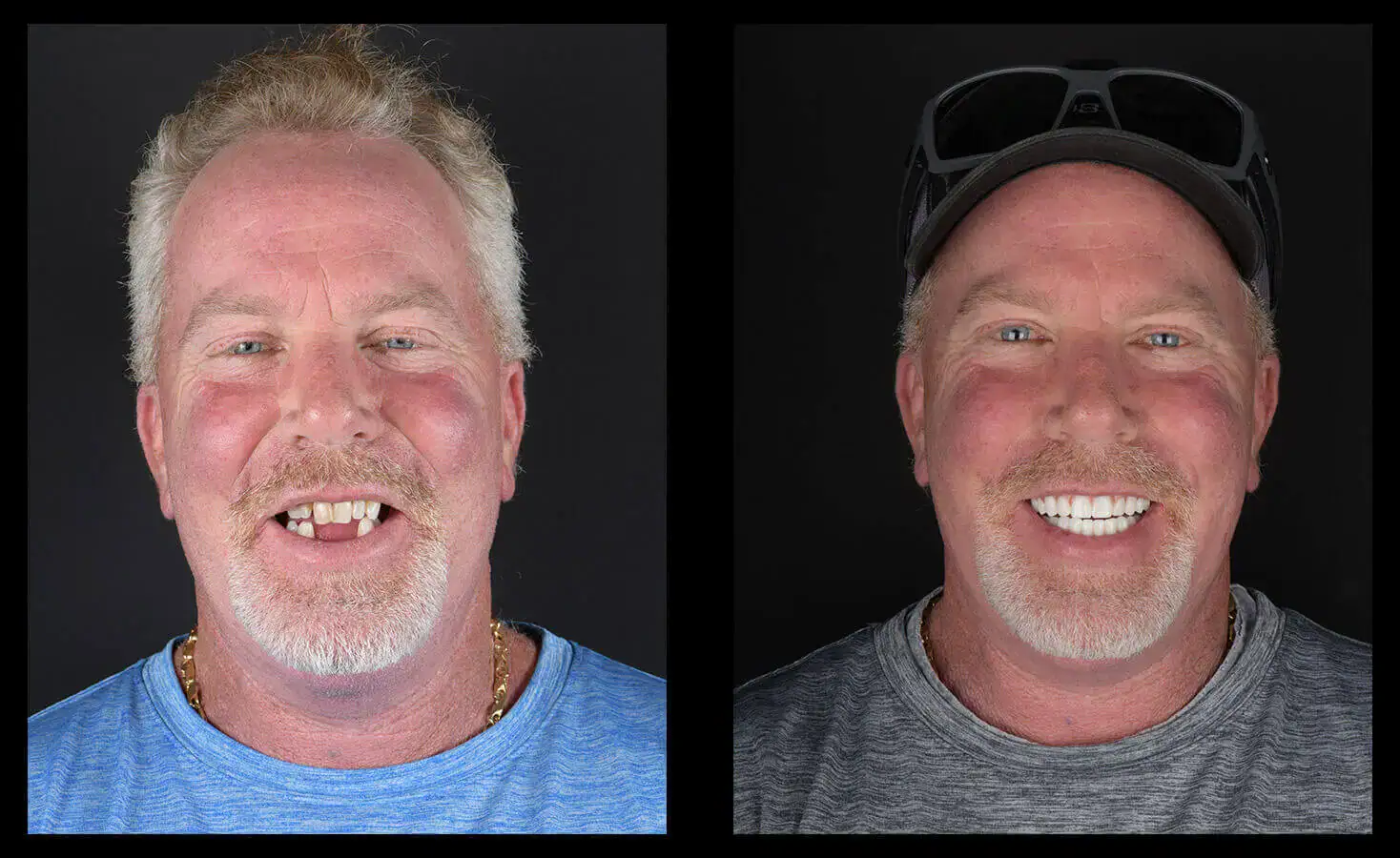 dental implants austin