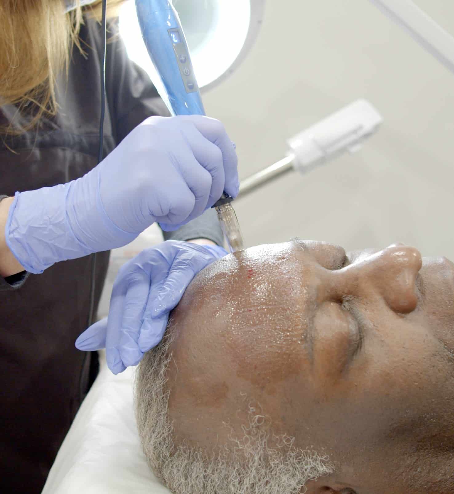 Microdermabrasion procedure on man's forehead at BYou Laser Clinics in New York.