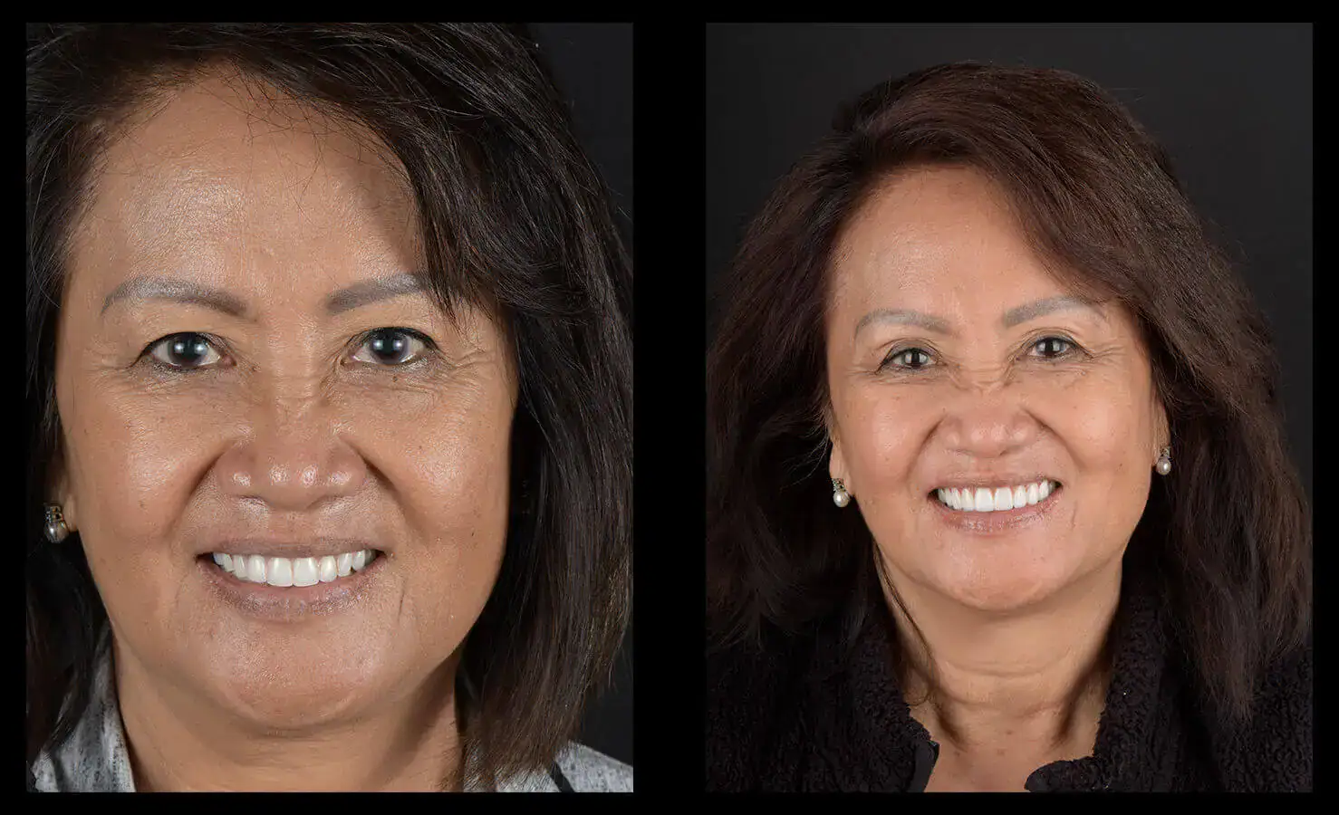 dental implants austin