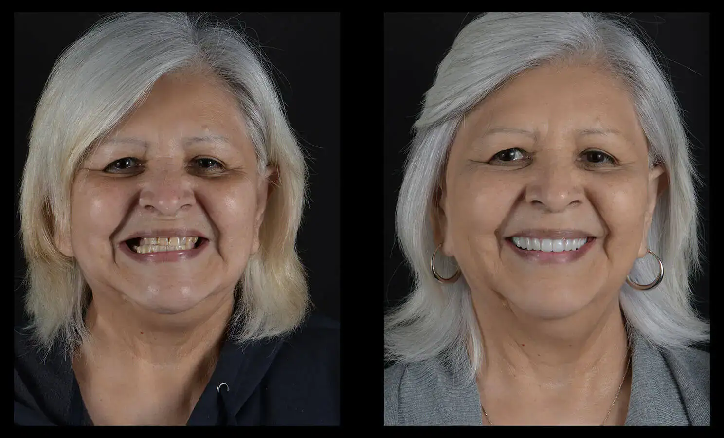 dental implants austin