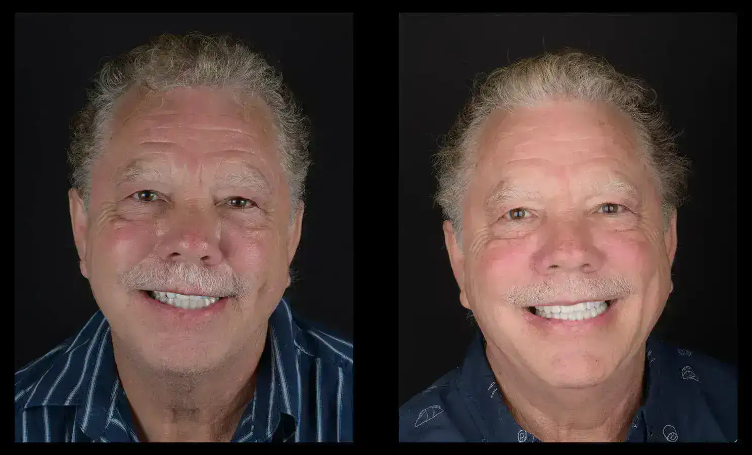 dental implants austin