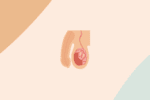 prostatite