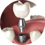 Coroana Zirconiu pe implant dentar