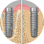 Osteointegrare implant dentar