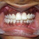 Depigmentation-Before