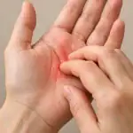 Paume de main gauche qui démange avec sensation de picotement visible.