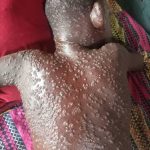 Le virus de Mpox