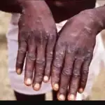 Le mpox en Afrique : une situation d'urgence de santé publique
