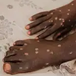 Les gouttelettes : une voie de transmission mineure du mpox