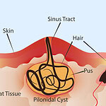 Affected Area of Pilonidal Cysts