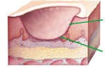 Mouth Ulcers