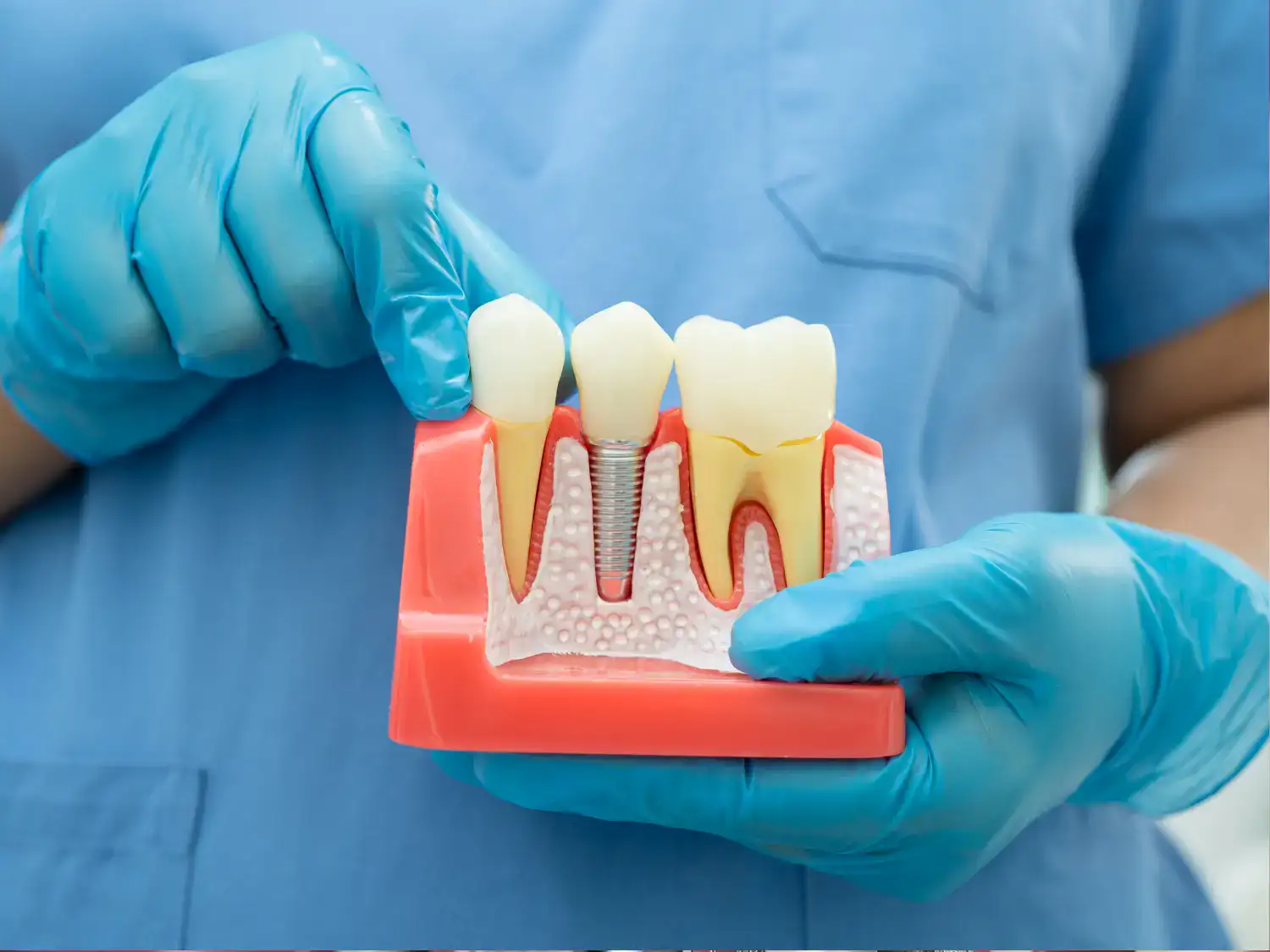 زراعة الأسنان