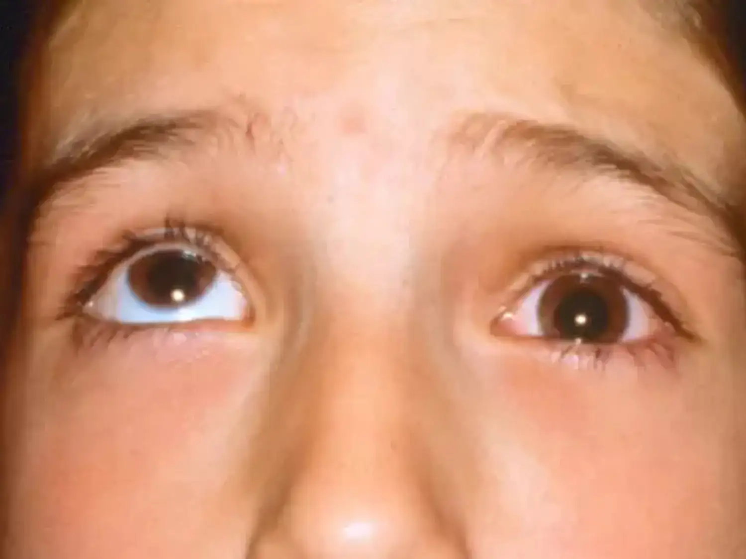 علاج كسور العين