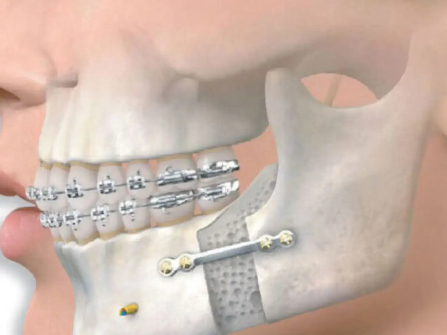 التقويم الجراحي للفكين