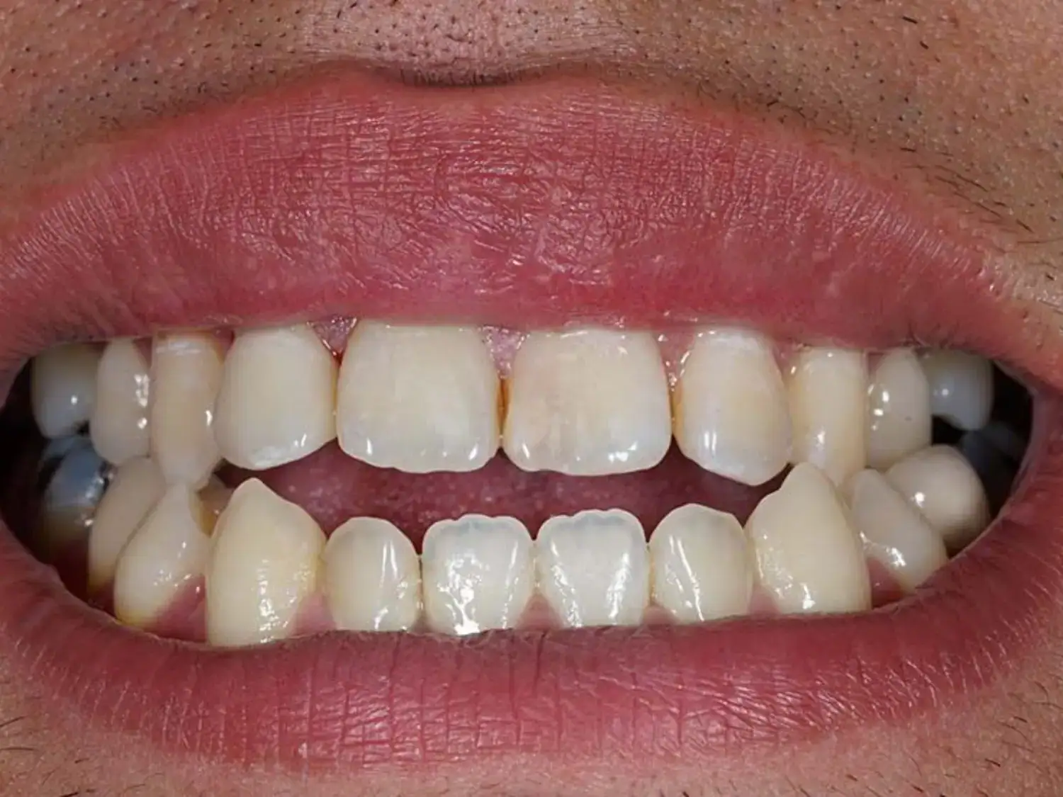 علاج العضة المفتوحة