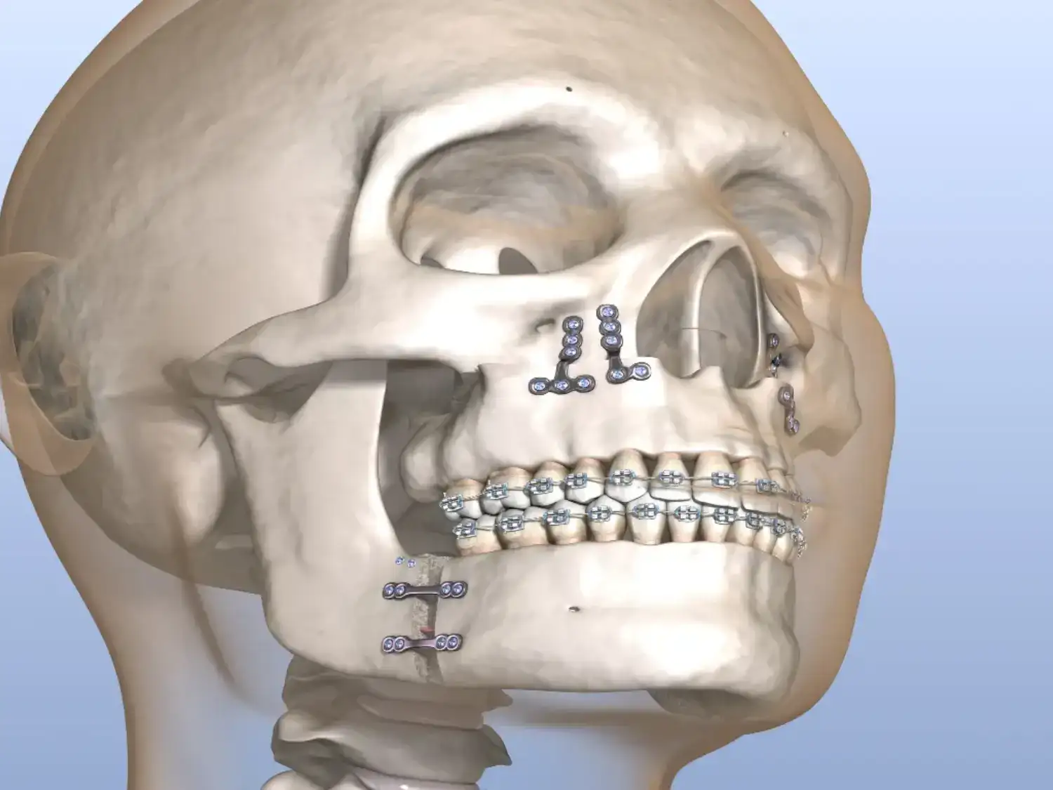 علاج كسور الوجه والفكين