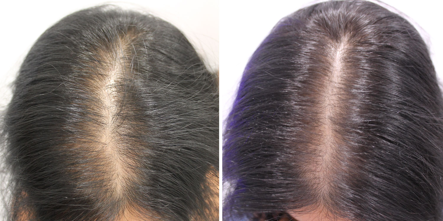 Mesoterapia capilar, tratamiento en Clínica Fontana Valencia