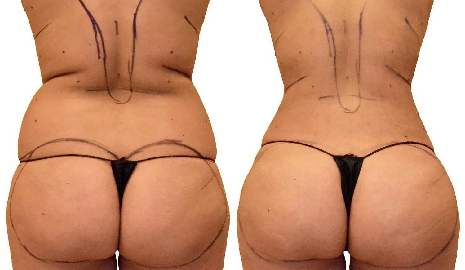 Lipo 360 before and after, actual patient of Dr. Long