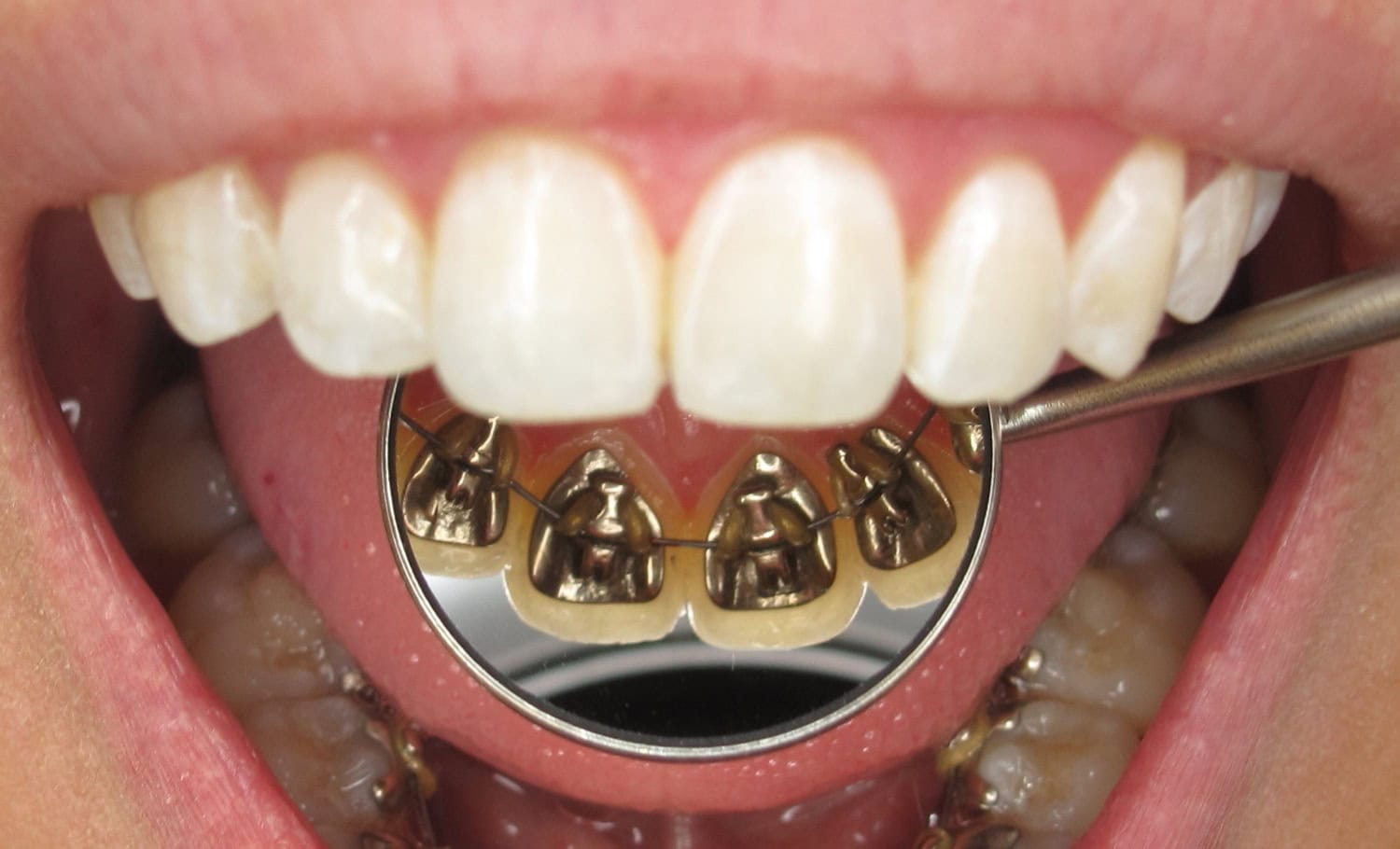 Dr. Gribalsky lingual braces Win system