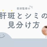 シミ・肝斑の見分け方について医師が解説