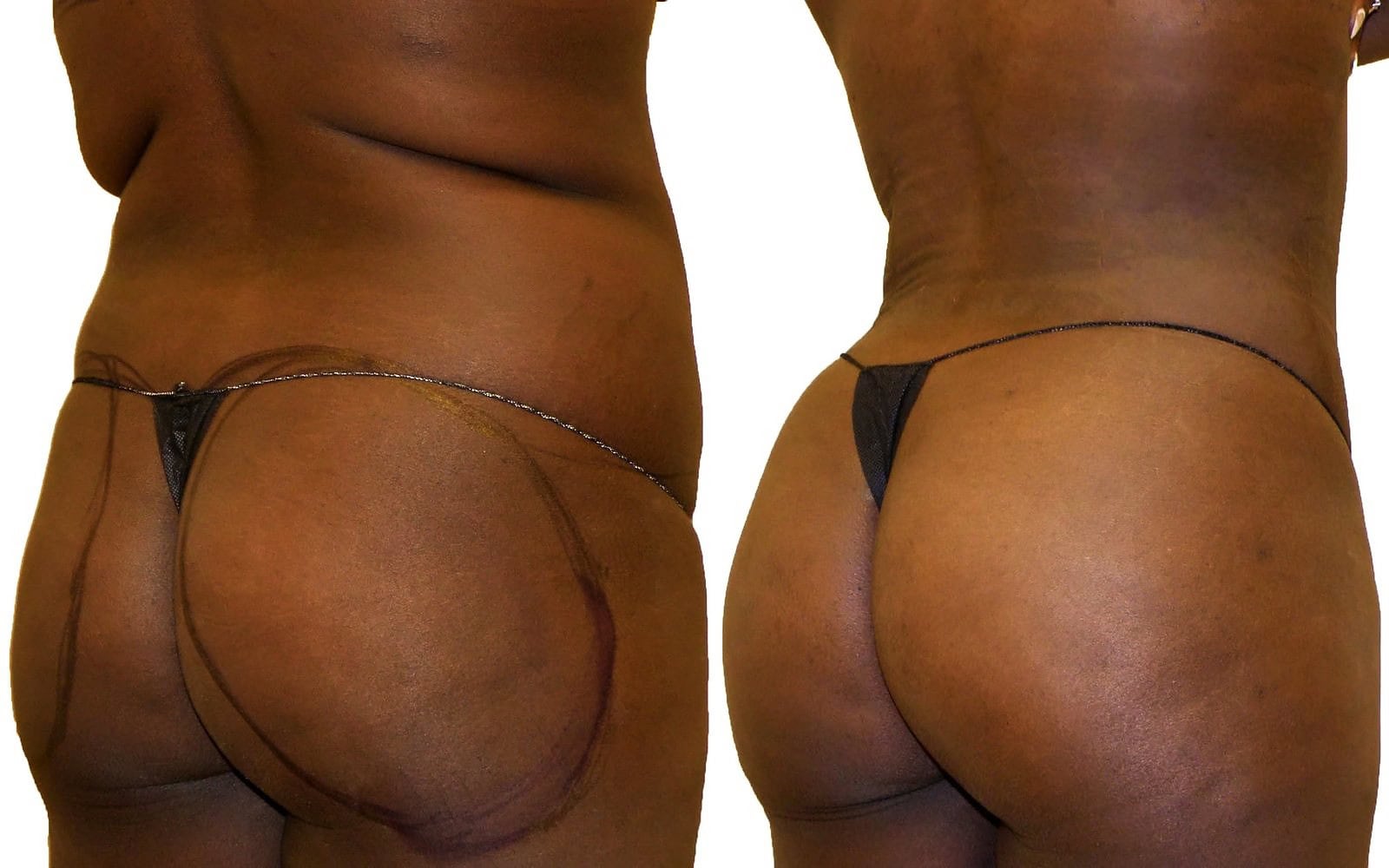 Fat Transfer, BBL before and after, actual patient of Dr. Long
