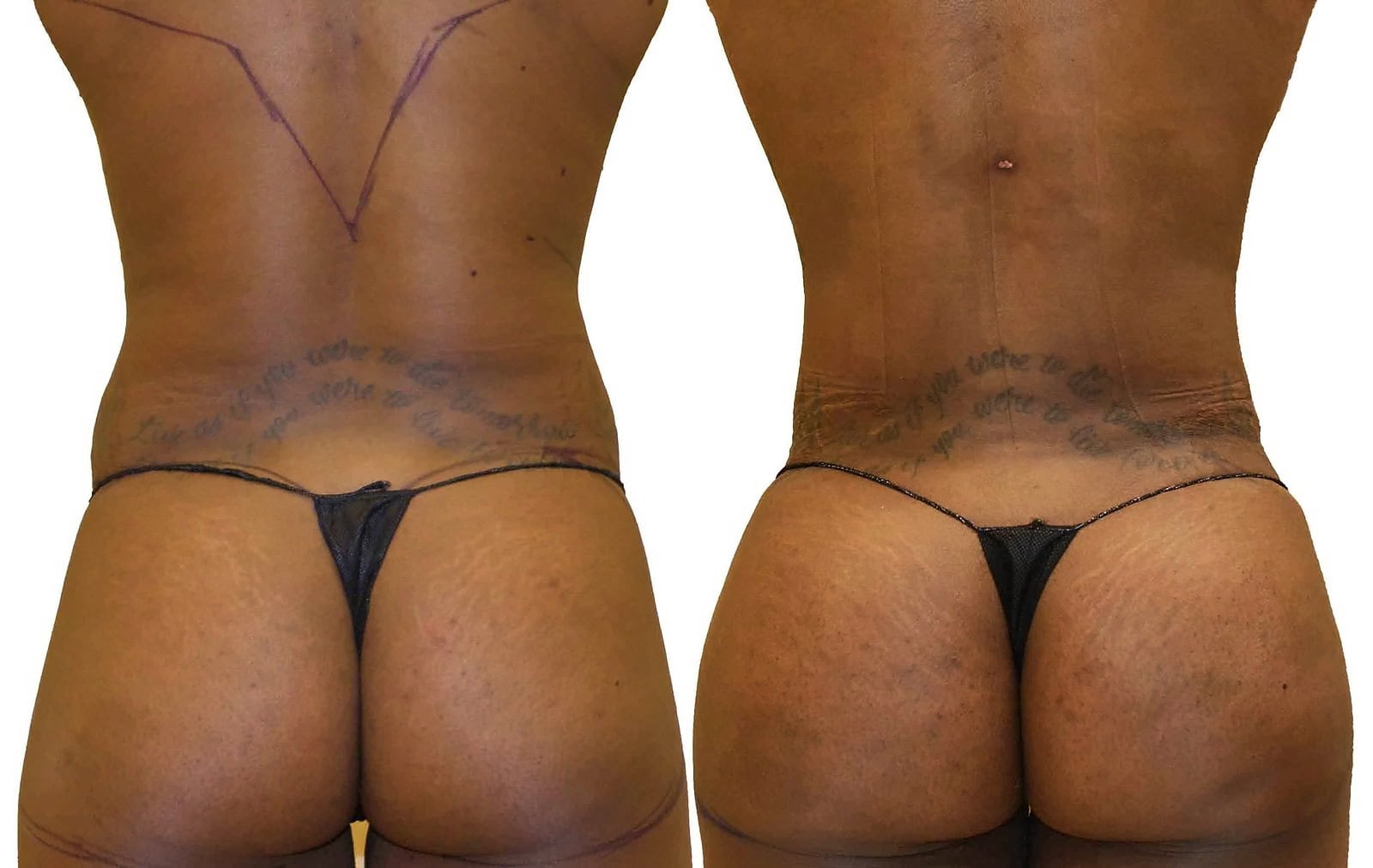 Fat Transfer, BBL before and after, actual patient of Dr. Long