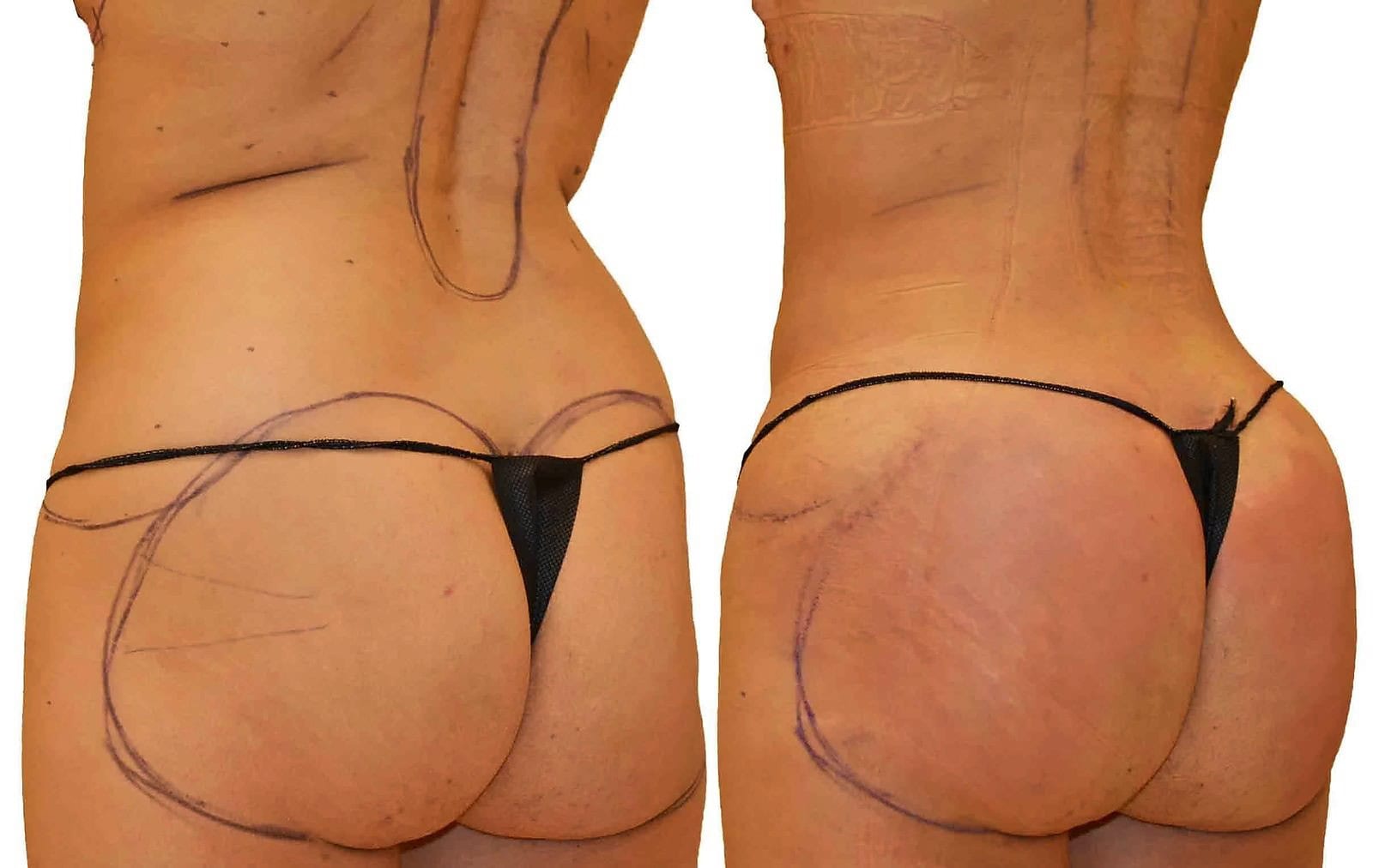 Fat Transfer, BBL before and after, actual patient of Dr. Long