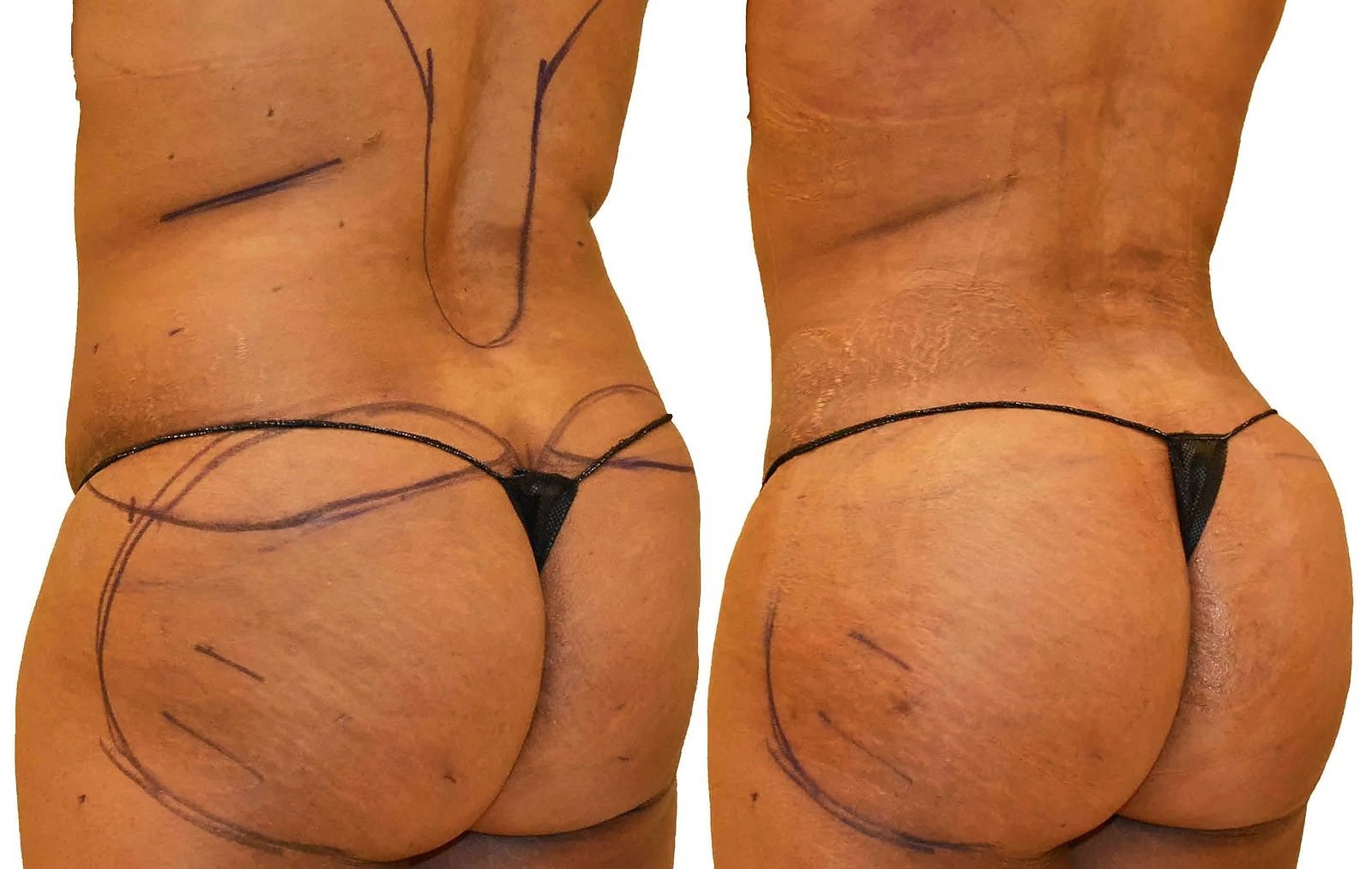 Fat Transfer, BBL before and after, actual patient of Dr. Long