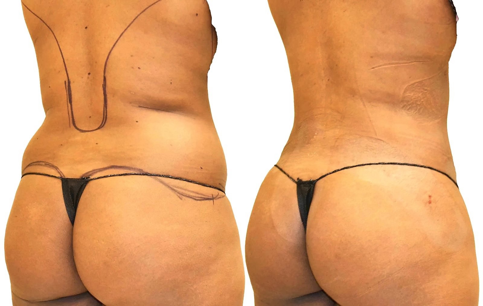 Fat Transfer, BBL before and after, actual patient of Dr. Long