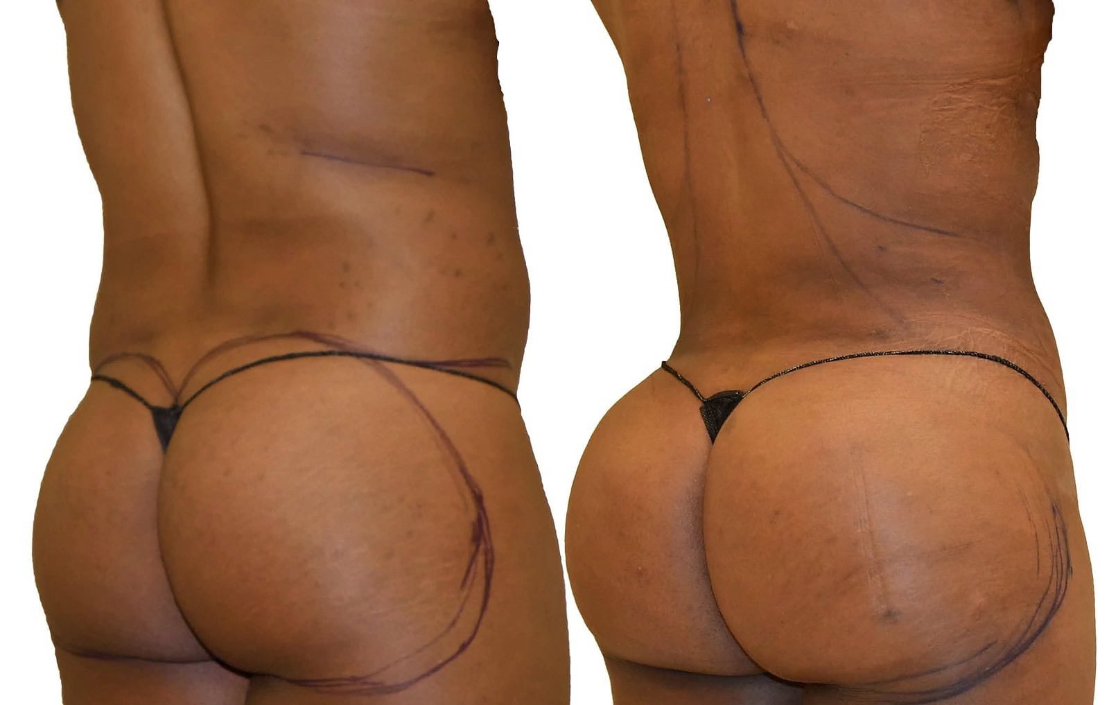 Fat Transfer, BBL before and after, actual patient of Dr. Long