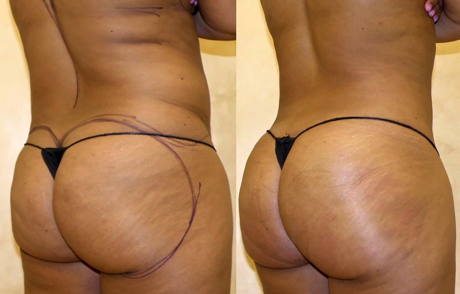 Fat Transfer, BBL before and after, actual patient of Dr. Long
