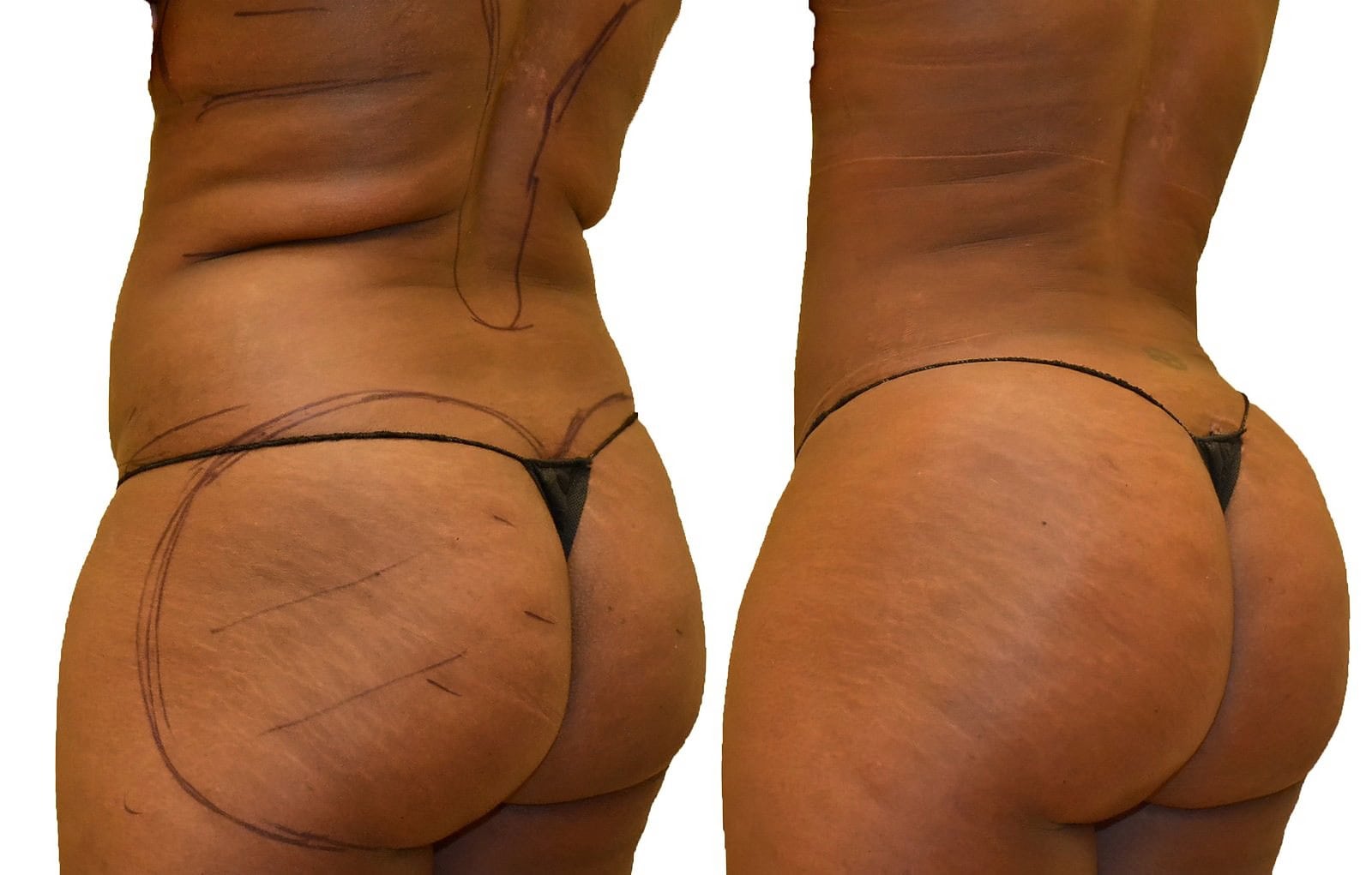 Fat Transfer, BBL before and after, actual patient of Dr. Long