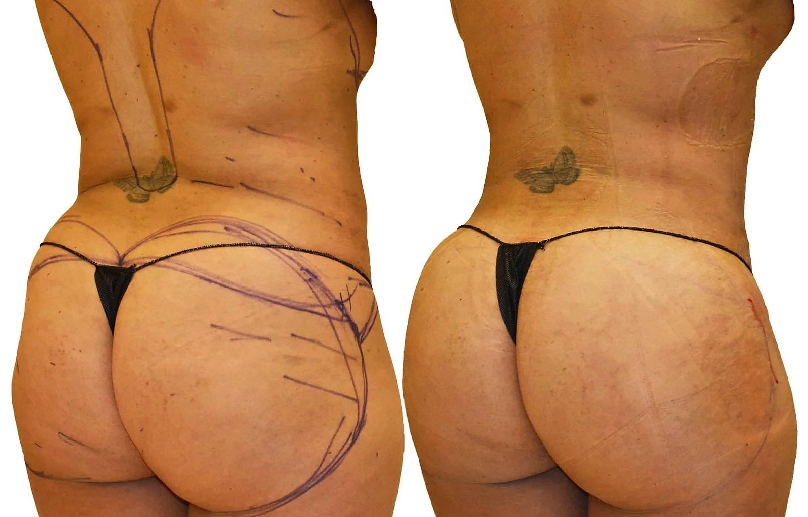 Fat Transfer, BBL before and after, actual patient of Dr. Long