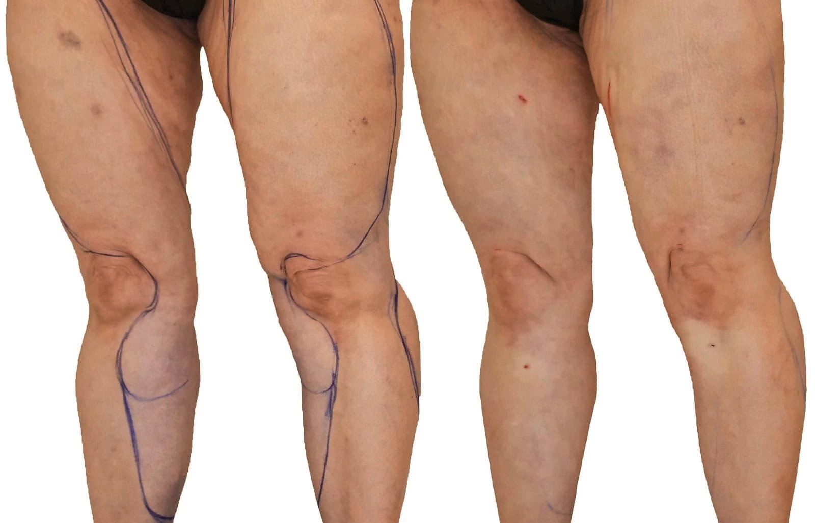 Lipedema liposuction before and after, actual patient of Dr. Long