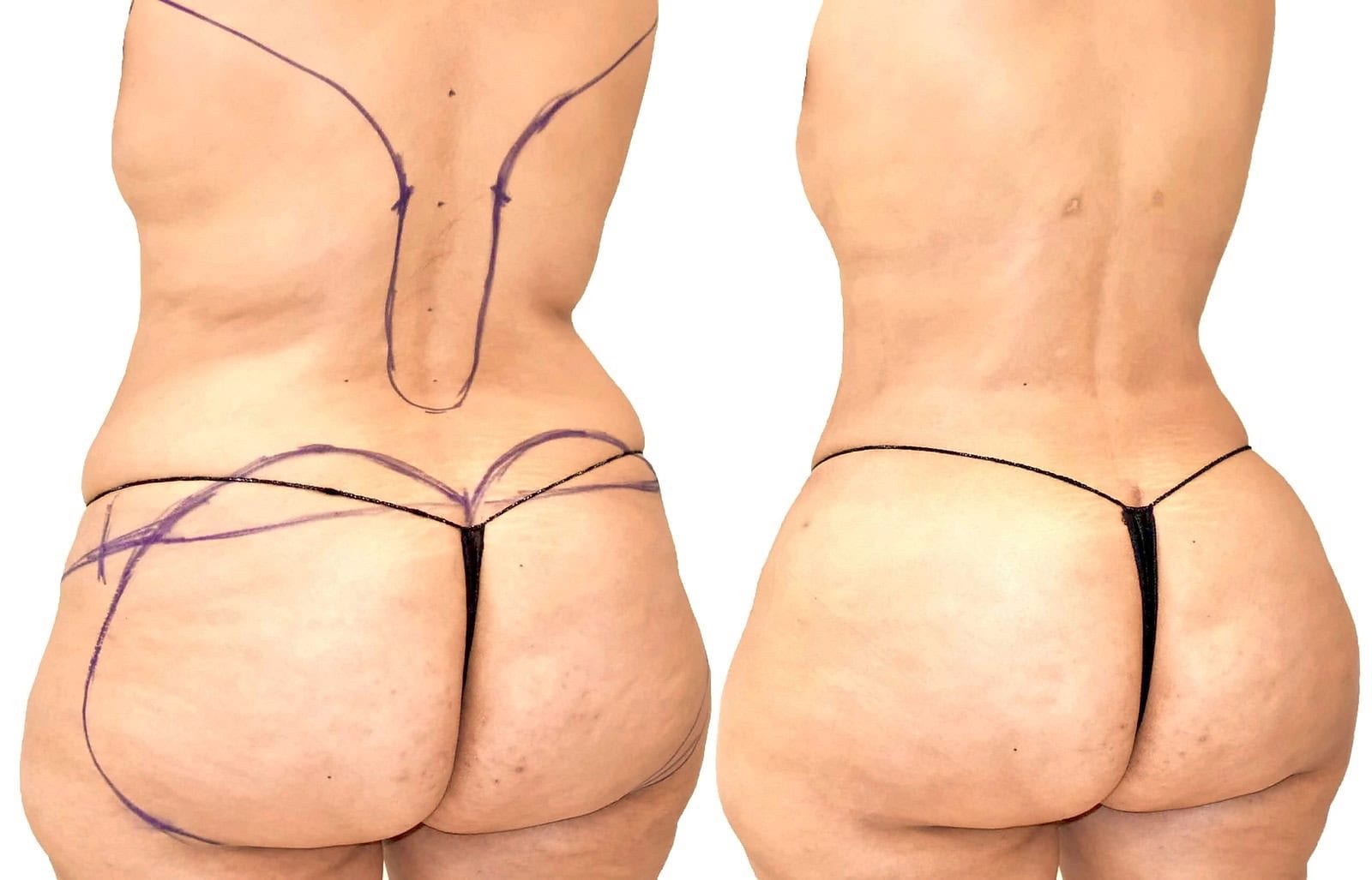 Fat Transfer, BBL before and after, actual patient of Dr. Long